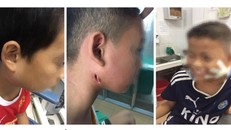 Ba bệnh nhi mắc bệnh Whitmore đang có chuyển biến tốt. Ảnh: BV Sản nhi Nghệ An