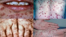 Sự trở lại của căn bệnh bị 'lãng quên'