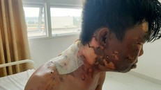 Thanh niên bị chị ruột đổ nước sôi vào đầu