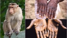 Số ca mắc đậu mùa khỉ ở 59 quốc gia đã vượt mốc 6.000