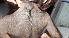  Hơn nữa phần lưng bé gái lông đen mọc dày đặc và đang phát triển tiếp. Ảnh: Phúc Hưng.