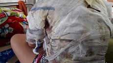 Chị Vui bị bỏng nặng khắp người. Ảnh: Lam Sơn.