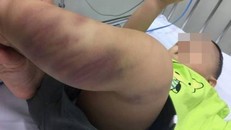 Hai chân bé chằng chịt vết lằn ngang dọc. Ảnh: Bệnh viện cung cấp.