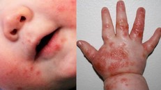 Bệnh tay chân miệng gây tổn thương ở da vùng họng, quanh miệng, bàn tay...