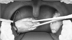 Việc cắt amidan phải có chỉ định của bác sĩ, căn cứ vào tình trạng bệnh lý