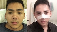 Ngọc Thắng trước và sau khi vừa phẫu thuật nâng mũi.