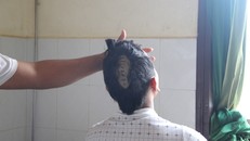 K' Đích bị chém nứt sọ và gãy 2 ngón tay trái đang điều trị tại Bệnh viện Đa Khoa II Bảo Lộc (Lâm Đồng).