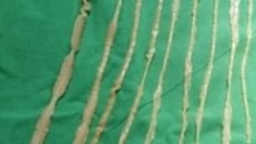 Hình ảnh giun sán dây cá dài 2,6 m được lấy từ ruột em bé 8 tuổi, giấu tên, người Đài Loan. Ảnh: Taipei Tri-Service General Hospital.