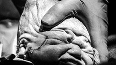 Hình ảnh đen trắng cho thấy đầu của Graham trông giống như một chiếc nón không đều sau khi ra khỏi bụng mẹ. Ảnh: Kayla Reeder.