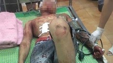 Nạn nhân được cấp cứu tại BV