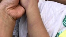 Thực hư chuyện bé trai 3 tuổi bị cô giáo đánh bầm tím chân tay