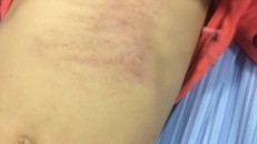 Vết bầm tím trên người cháu bé. Ảnh: PLO