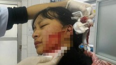 Vết thương của nạn nhân L. kéo đến tận mang tai. Ảnh: PLO