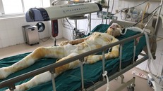 Nạn nhân H. bị bỏng 95% cơ thể. 