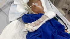 Bé trai 9 tuổi đang được điều trị tại Bệnh viện Hữu nghị Việt Nam Cuba Đồng Hới. Ảnh: Zing