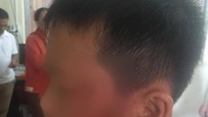 Vết bầm tím trên mặt cháu T. Ảnh: NLĐ