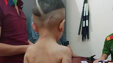 Các thương tích trên người bé Huy. Ảnh: VOV