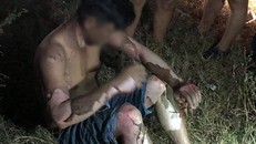 Nạn nhân nam bị bỏng nặng khắp người. Ảnh: Facebook