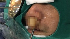 Khối u được các bác sĩ lấy ra từ khoang mũi của bệnh nhân. Ảnh: BVCC.