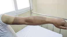 Cánh tay bị bỏng của một trong các nạn nhân. Ảnh: BVCC