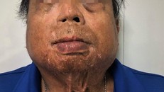 Nạn nhân bị bỏng nặng do vợ tạt axit. Ảnh: BSCC