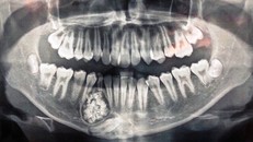 Khối u răng của bệnh nhân qua phim X-quang. Ảnh: Thanh Niên