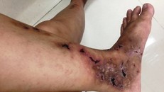 Đáng sợ bệnh dễ nhầm lẫn với tiểu đường, khiến người bệnh phải cắt cụt chi