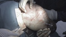 Túi ối vẫn còn nguyên vẹn khi được lấy ra từ bụng thai phụ. Ảnh: BVCC