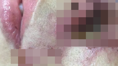 Mũi mưng mủ, có dấu hiệu hoại tử sau khi tiêm filler