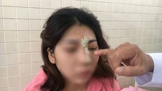 Tiêm filler tại spa, nữ bệnh nhân bị mù mắt trái