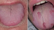 Sàng lọc COVID-19 qua triệu chứng ở lưỡi