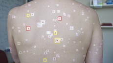 Phát triển mô hình AI hỗ trợ điều trị ung thư da