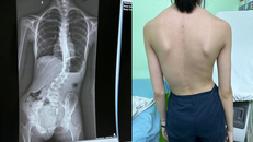 Cong vẹo cột sống: Đừng để quá cong mới đi khám