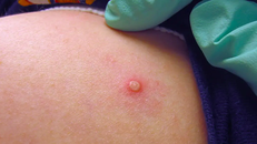 TP HCM ghi nhận 13 ca bệnh đậu mùa khỉ​