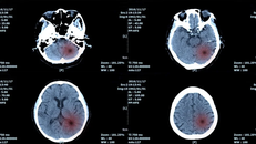 Sử dụng AI để phân tích khối u não ác tính