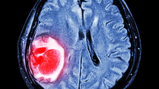 Dùng AI để dự đoán chính xác hơn nguồn gốc các khối u