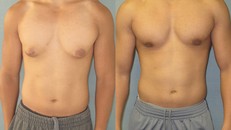 Cơ thể thiếu loại hormone này, ngực nam giới có thể phát triển to giống nữ giới