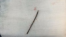 Chiếc kim rỉ sét được lấy ra từ lồng ngực bé gái