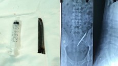 ưỡi dao Thái Lan trong cơ thể bệnh nhân trên phim X-quang và lưỡi dao khi được lấy ra. 