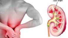 Bị sỏi thận nên ăn uống như thế nào?