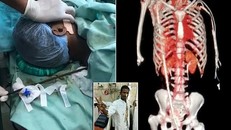 Thoát chết hy hữu khi thanh thép xuyên dọc từ háng lên cổ