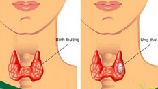 Ung thư tuyến giáp trạng là gì?
