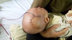 Ngã từ trên giuờng xuống, bé trai 9 tháng tuổi bị lún sọ não