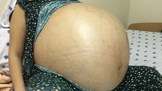 TP.HCM: Phẫu thuật lấy khối u buồng trứng lớn hiếm thấy 