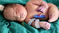 Bé sơ sinh mắc hội chứng 'nàng tiên cá' chào thế giới 15 phút thì qua đời