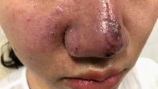 Hà Nội: Méo mặt, mũi bọc mủ vì tiêm filler làm đẹp