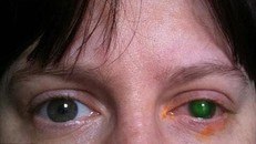 Bà Jenkins với bên mắt trái ánh lên màu xanh lục khi các bác sĩ dùng thuốc nhuộm xác định thương tổn. Toàn bộ vùng màu xanh là vết sẹo lớn gây mất thị lực - ảnh: PA Real Life