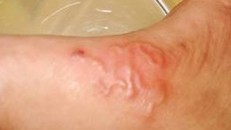 Bệnh ấu trùng sán lợn dưới da