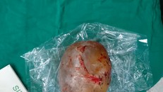 Bé trai 4 tháng tuổi phình to bụng vì mang 'thai trong thai' hiếm gặp