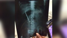 Hình ảnh chiếc kéo bị bác sĩ bỏ quên 3 tháng trong bụng bệnh nhân